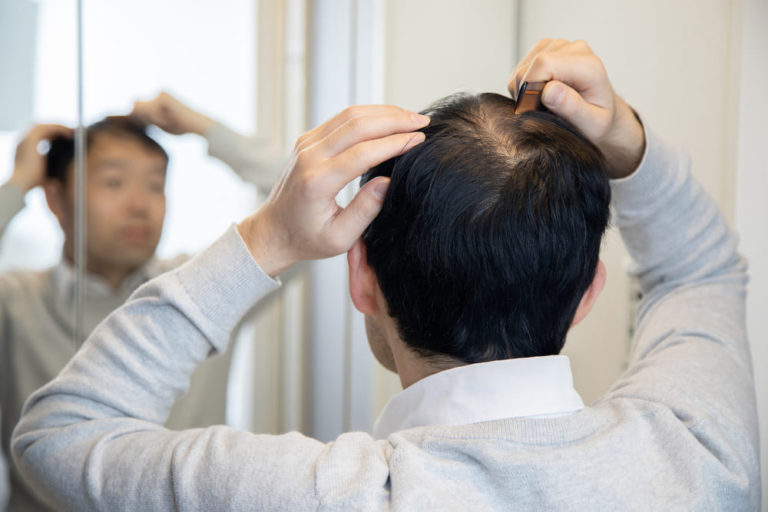 AGA治療のやめるべきではないタイミング