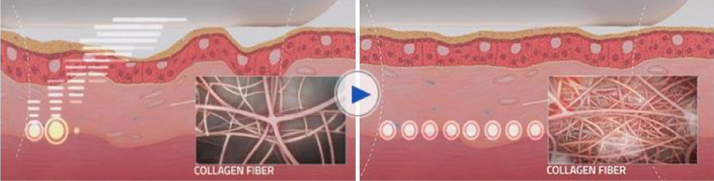 膣ハイフによるコラーゲンの増加