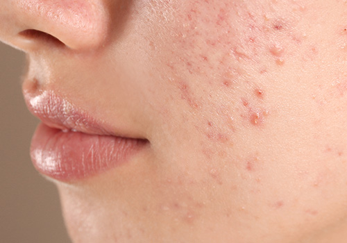 Acne Scars
