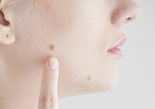 Warts & Moles