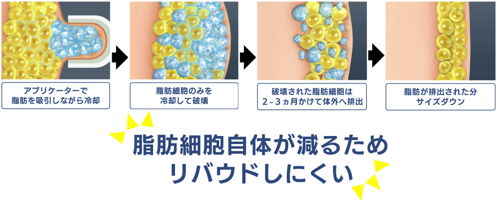 脂肪細胞自体が減るためリバウンドしにくいクールスカルプティング(クルスカ)