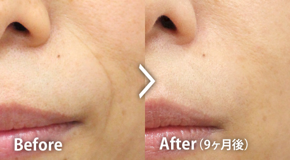 ほうれい線の症例写真 9か月後