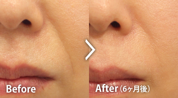 ほうれい線の症例写真 6か月後