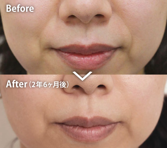 ほうれい線の症例写真