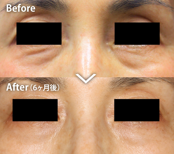 目元のたるみの症例写真