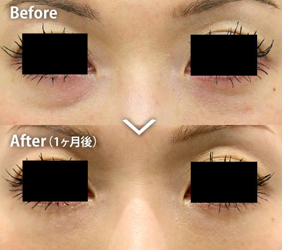 目のクマの症例写真 1か月後