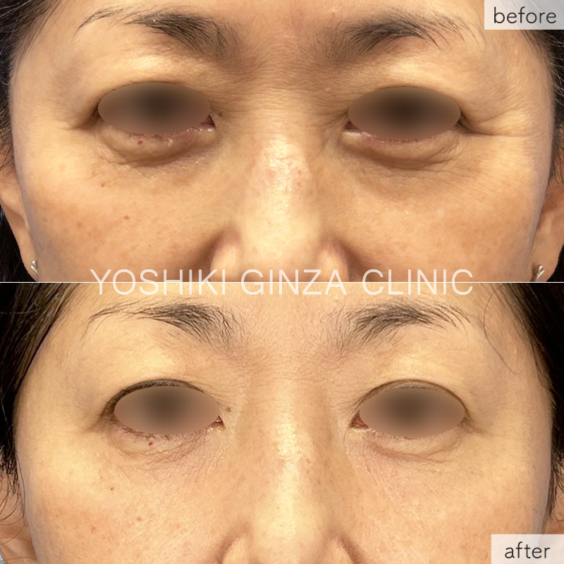 目元のクマの症例写真 2回施術3週間後