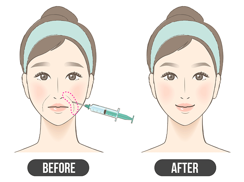 ヒアルロン酸注射イメージイラスト