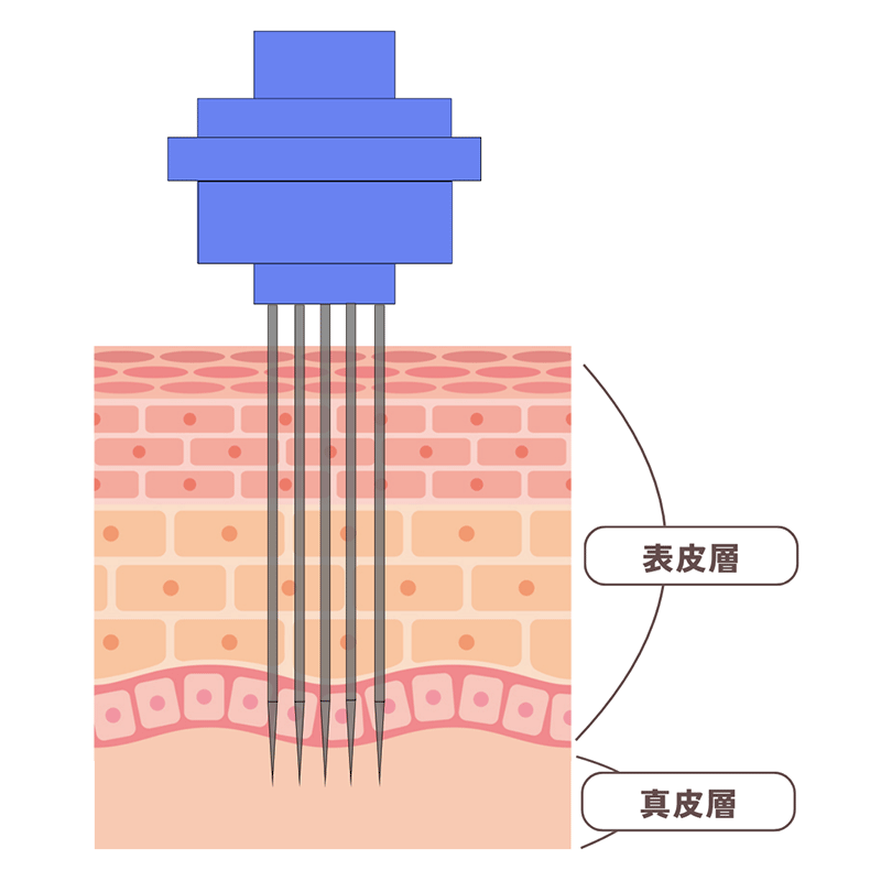 肌質改善ヒアルロン酸イメージイラスト