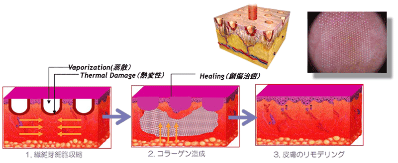 Effects of the Mona Lisa Touch