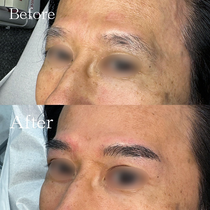 アートメイクの症例写真