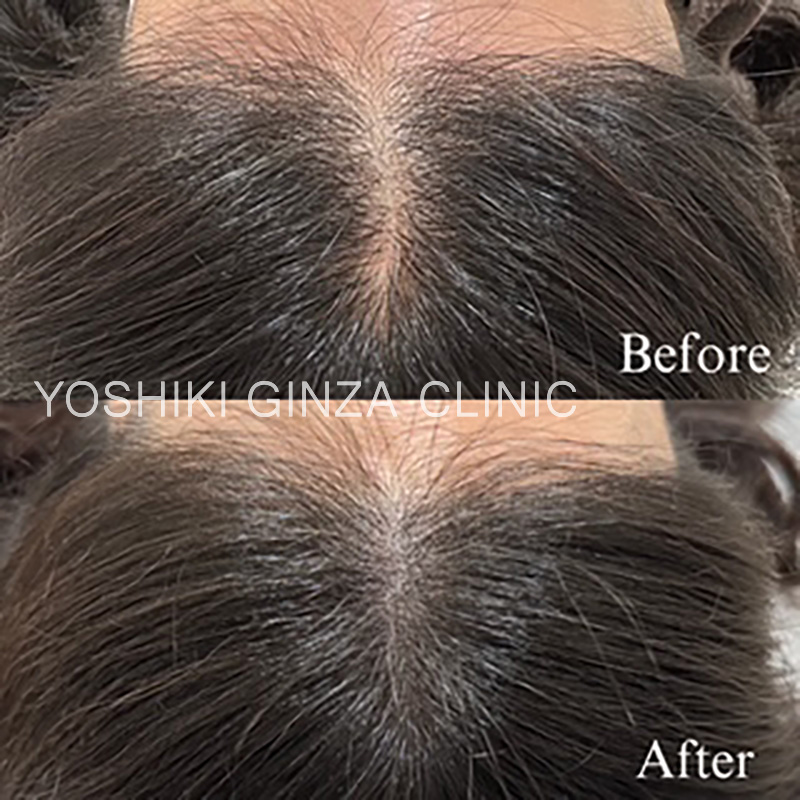 ヘアアートメイクの症例写真