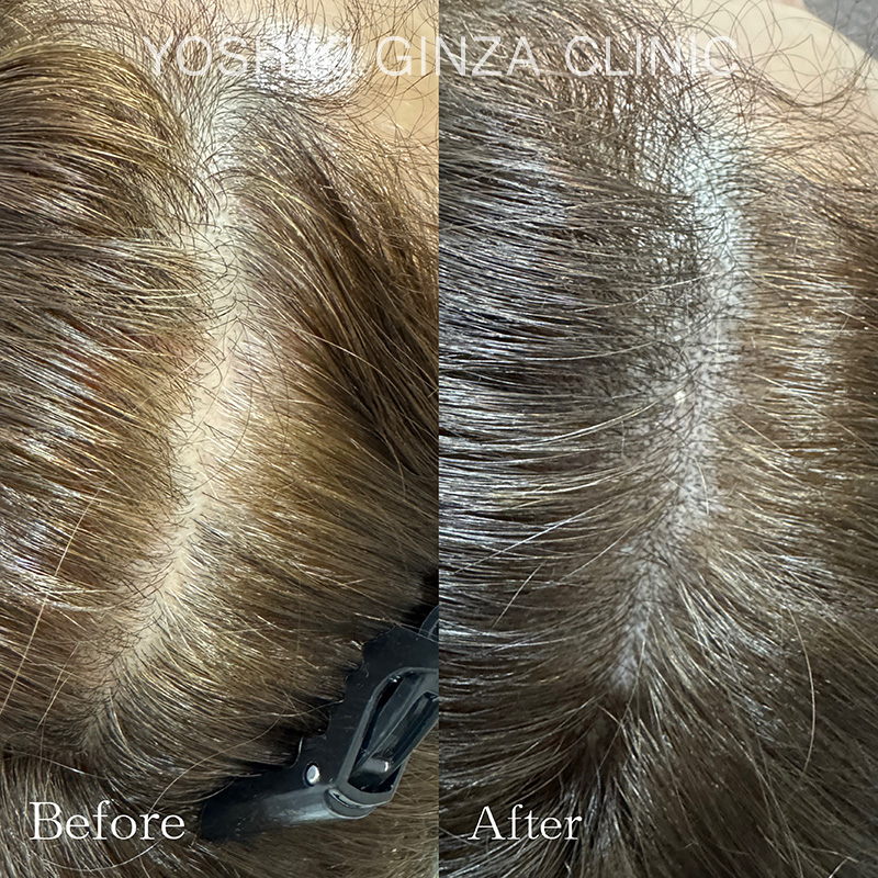 ヘアアートメイクの症例写真