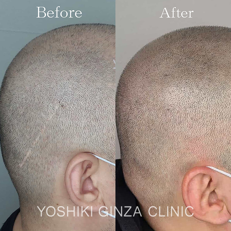 ヘアアートメイクの症例写真