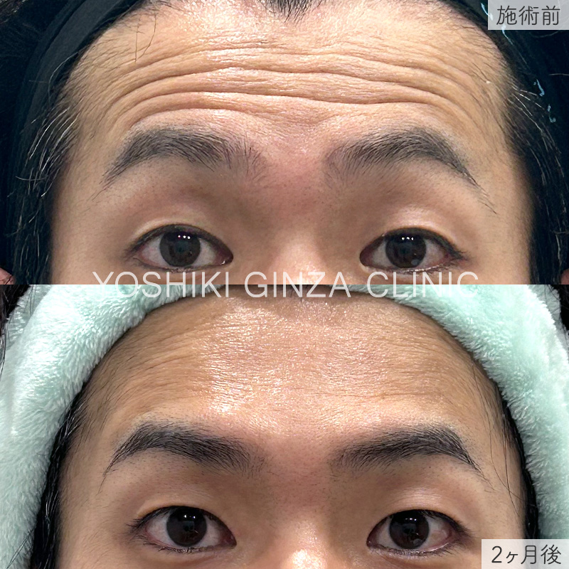 ボツリヌス注射（額）の症例写真
