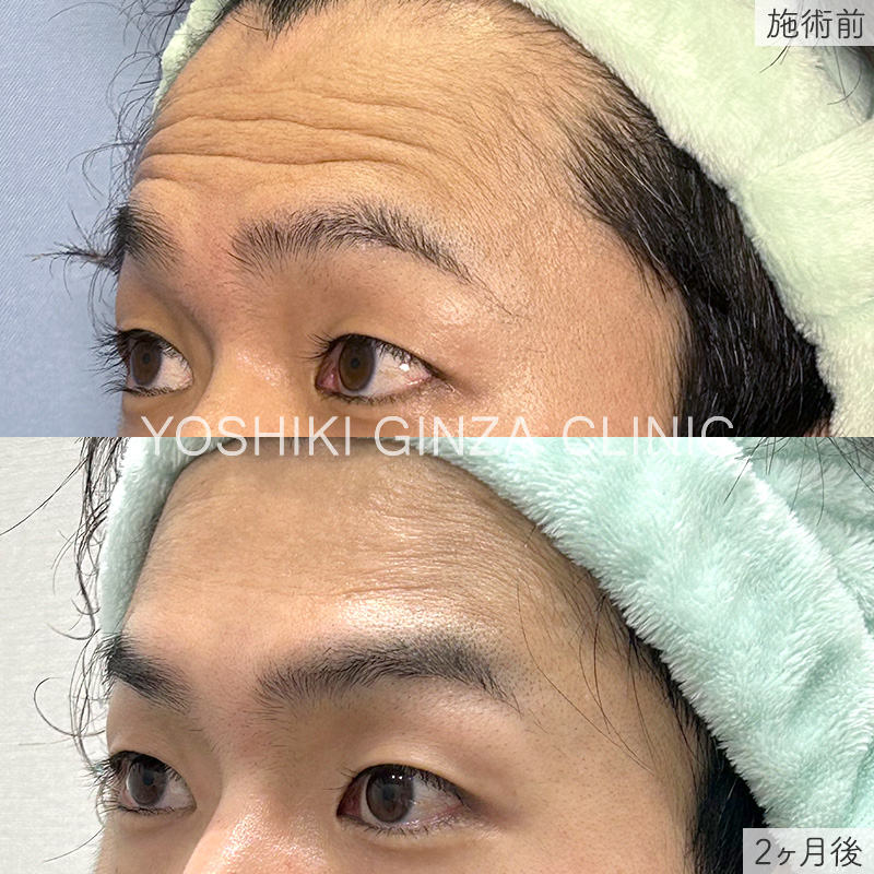 ボツリヌス注射（額）の症例写真
