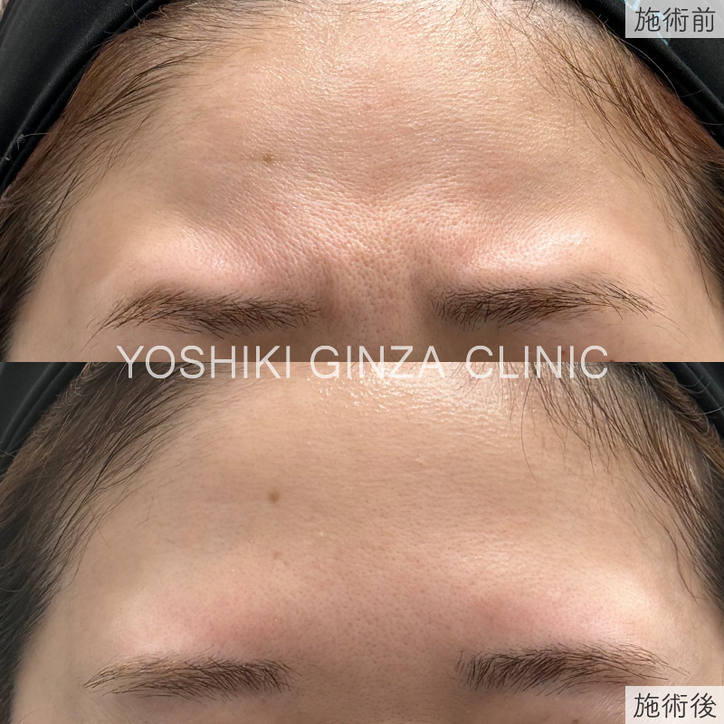 ボツリヌス注射（眉間）の症例写真