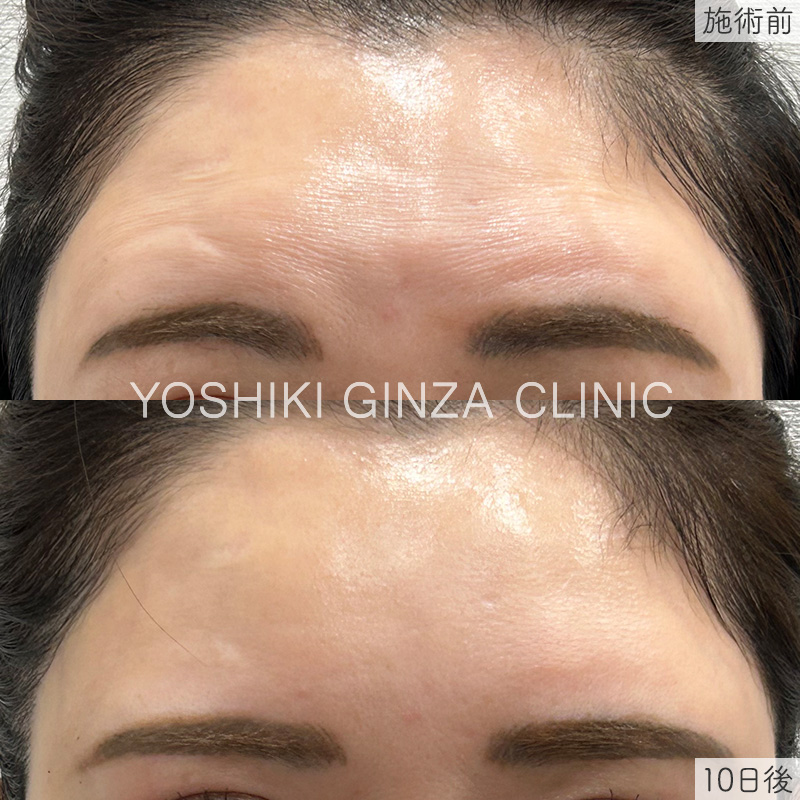 ボツリヌス注射（額）の症例写真