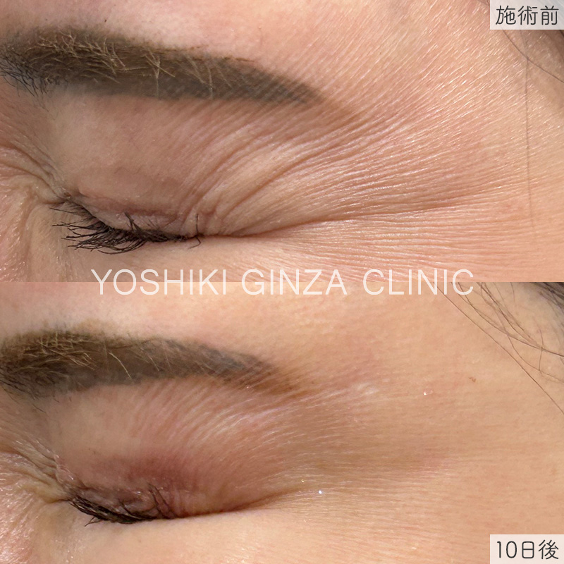 ボツリヌス注射（目尻）の症例写真