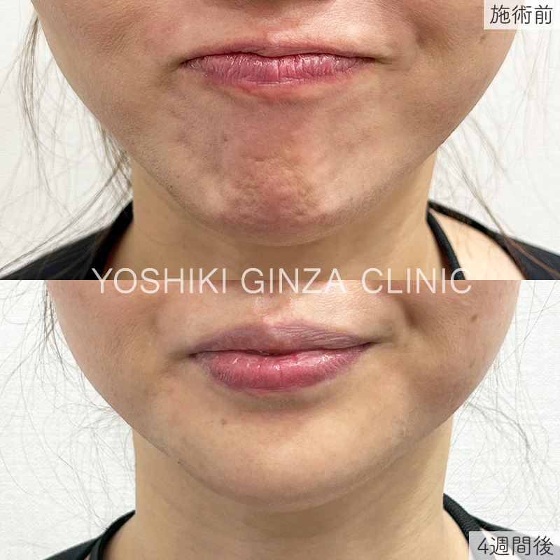 ボツリヌス注射（あご（梅干しジワ））の症例写真