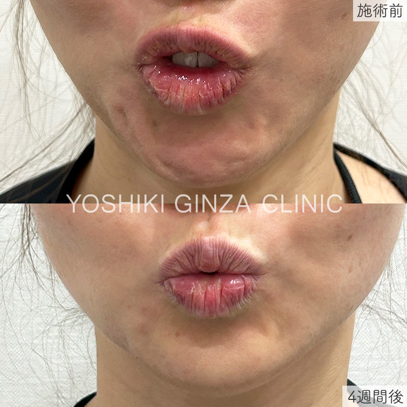 ボツリヌス注射（あご（梅干しジワ））の症例写真