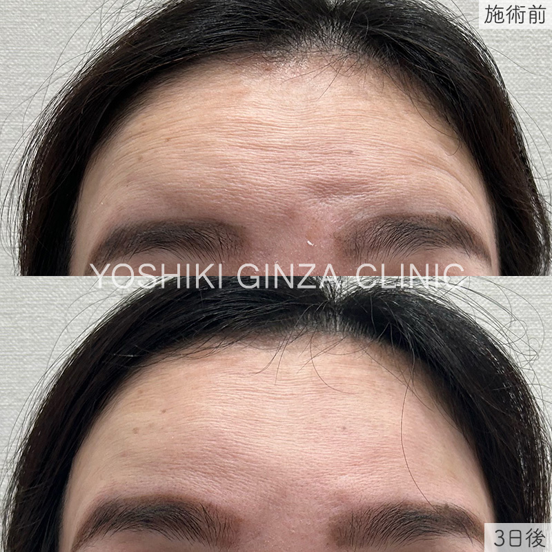 ボツリヌス注射（額）の症例写真