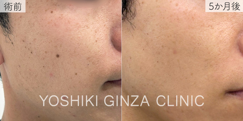 CO2レーザー ほくろの症例写真