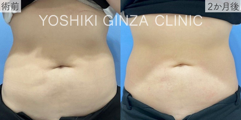 クルスカ 下腹部/両腹側部の正面の症例写真