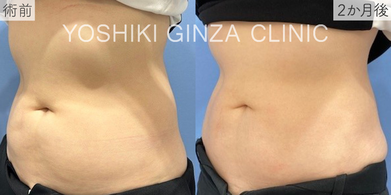 クルスカ 下腹部/両腹側部の斜めの症例写真