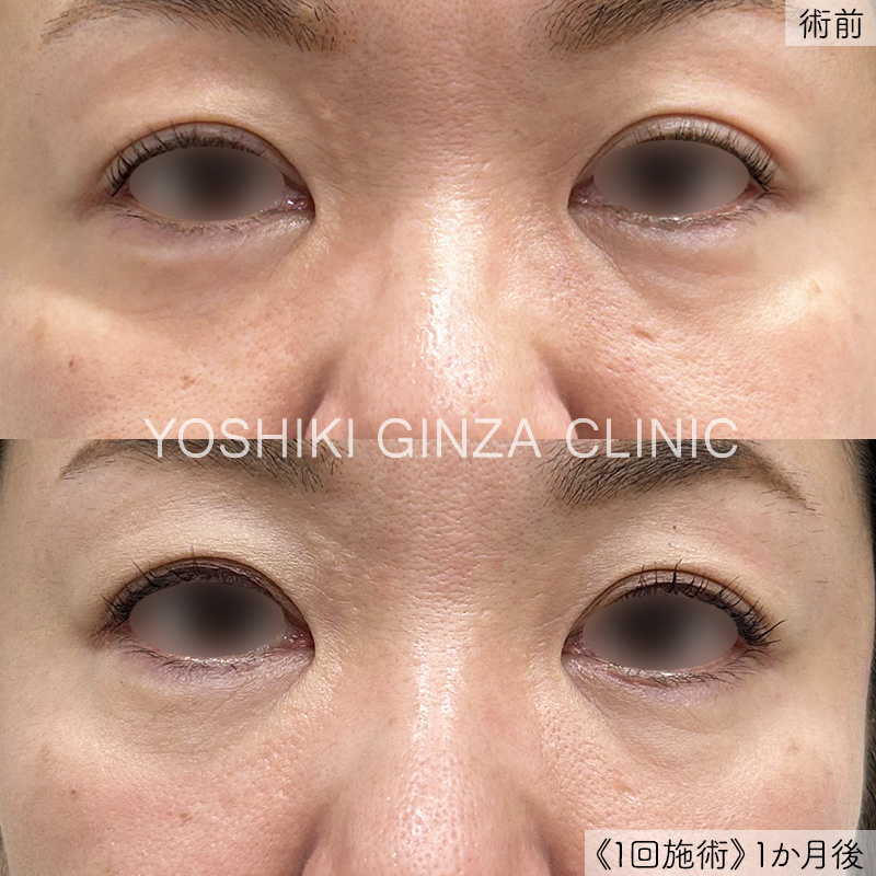 Upper & Lower Eye Area