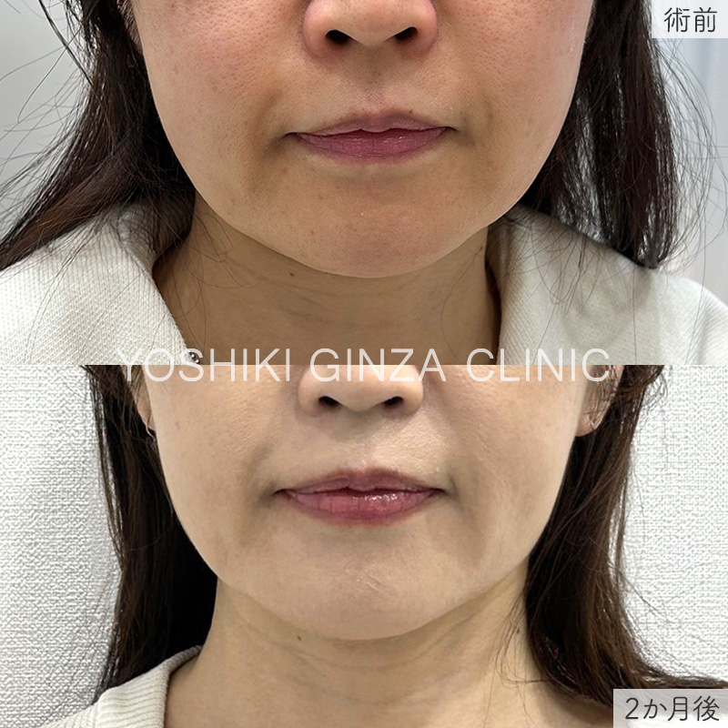 脂肪溶解注射の症例写真