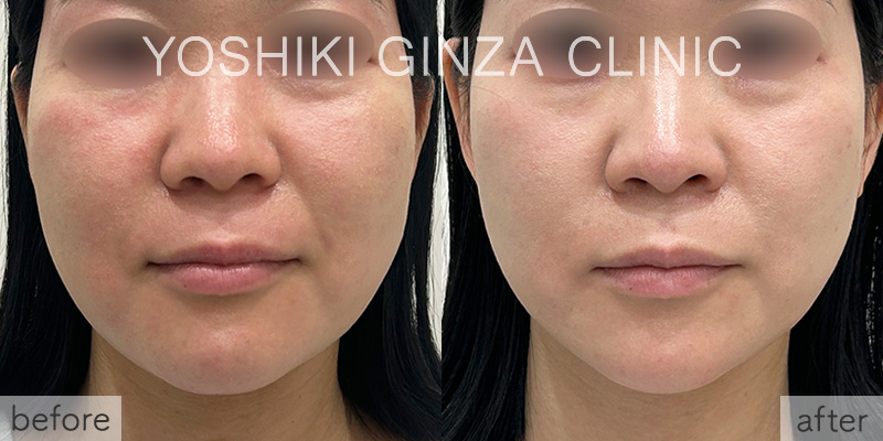 Before-and-after photos of fat-dissolving injections