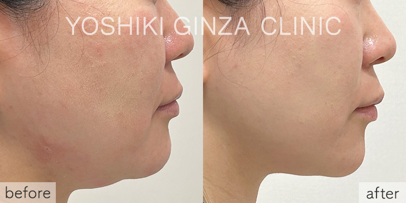 Before-and-after photos of fat-dissolving injections