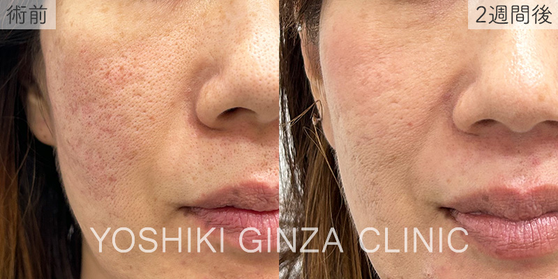 ジュベルック 両頬の症例写真