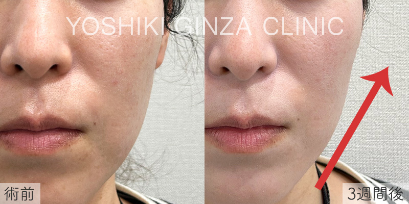 ジュベルック ゴルゴ線の症例写真