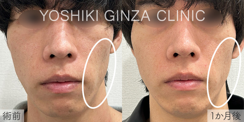 ジュベルック 左ほほの症例写真