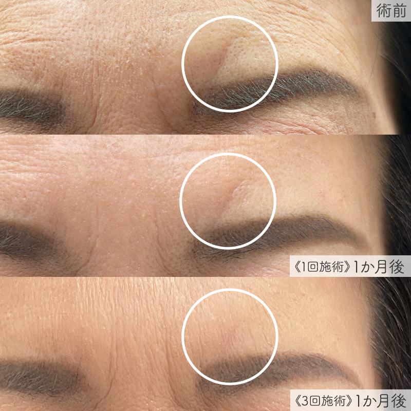 ジュベルック 傷痕の症例写真