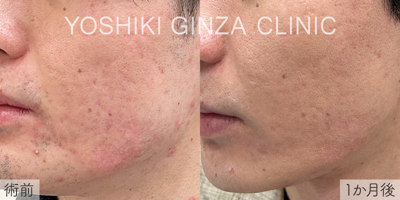 ジュベルック 両ほほニキビ跡の症例写真