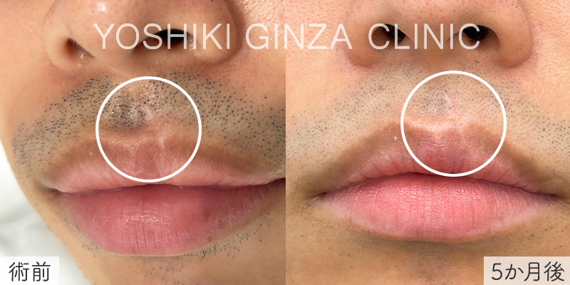 スターラックス＆ピコフラクショナルの症例写真