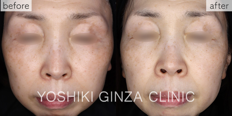 Mesona J Special Course