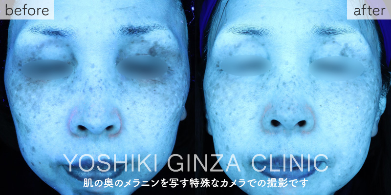 Mesona J Special Course