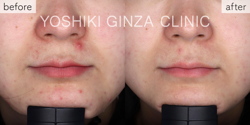 Mesona J Special Course