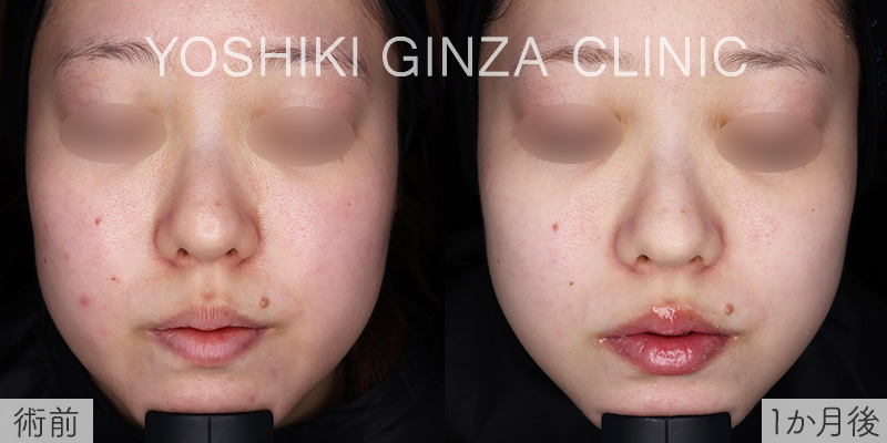 ミラノリピールの症例写真