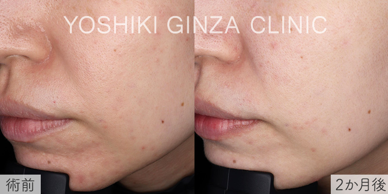 ミラノリピールの症例写真