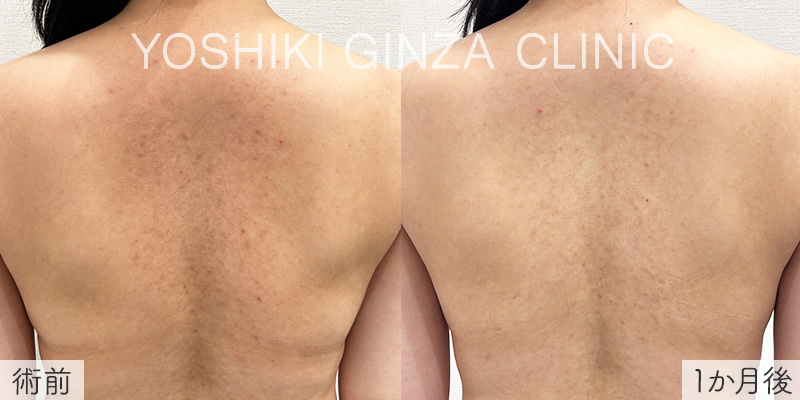 ミラノリピールの症例写真