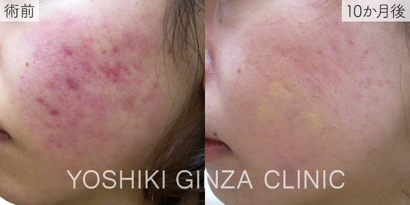 Chemical Peel – Before & After Photos