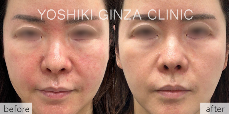 Chemical Peel – Before & After Photos