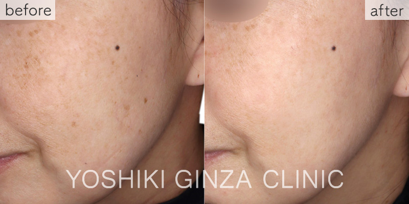 フォトフェイシャルステラ ほほ×3回の症例写真