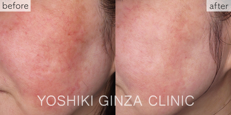 フォトフェイシャルステラ ほほ×3回の症例写真