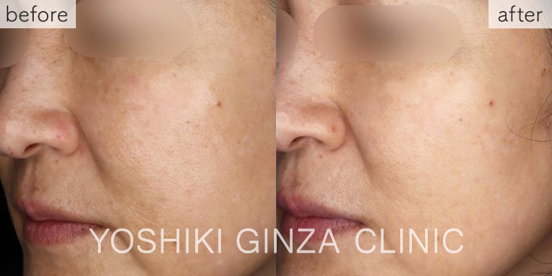 フォトフェイシャルステラ ほほ＋鼻あご×3回の症例写真